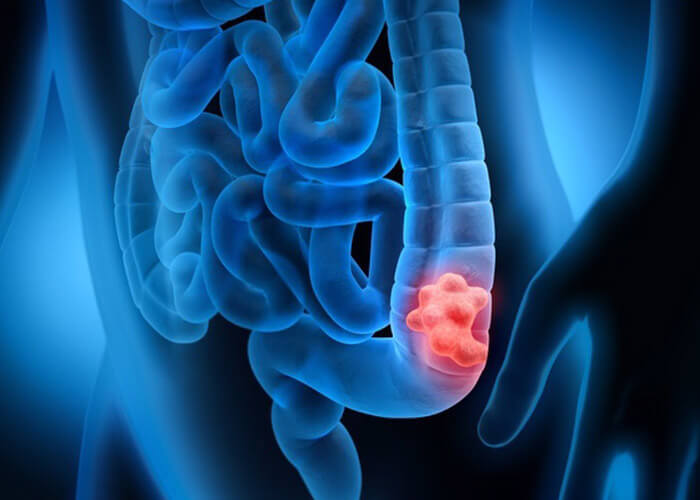 Cáncer de Colon