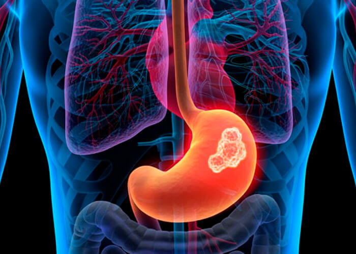 Cáncer de Estómago