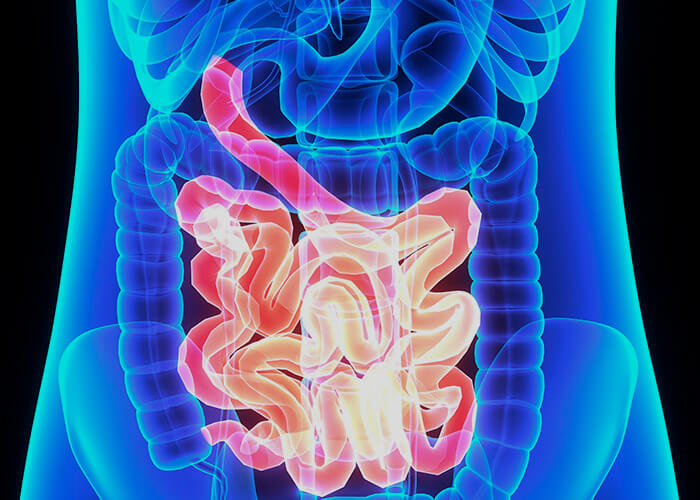 Cáncer de Intestino Delgado
