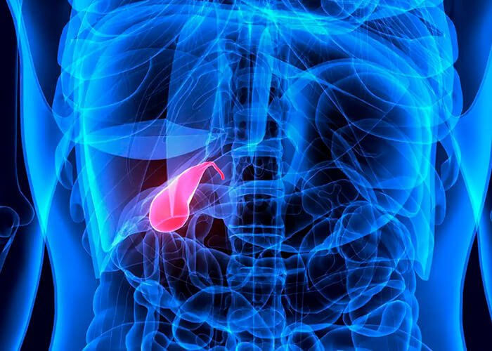Cáncer de Vesícula Biliar